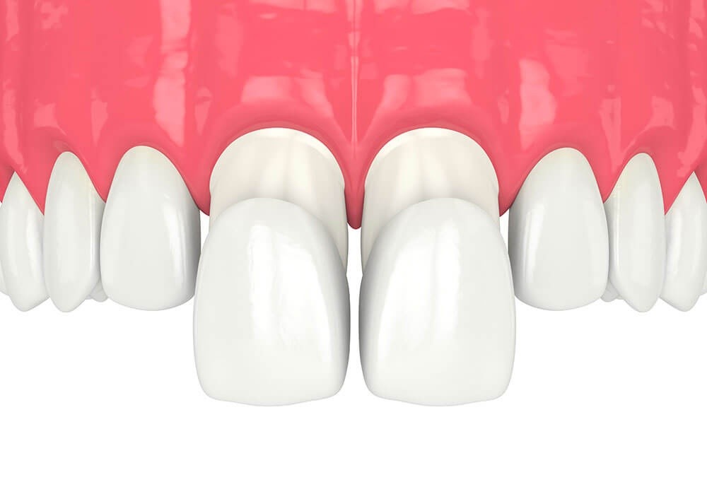 Dental veneers without grinding in Casablanca: is it possible?